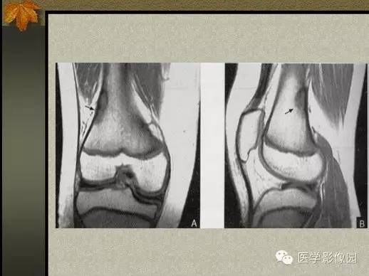 【PPT】纤维骨皮质缺损的影像诊断