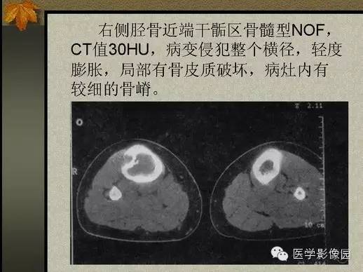 【PPT】纤维骨皮质缺损的影像诊断