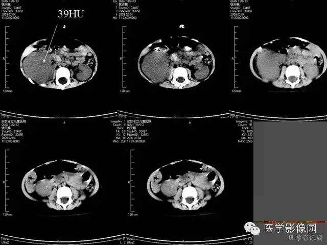 【病例】先天性中胚层肾瘤1例CT影像表现 【病例】先天性中胚层肾瘤1例CT影像表现