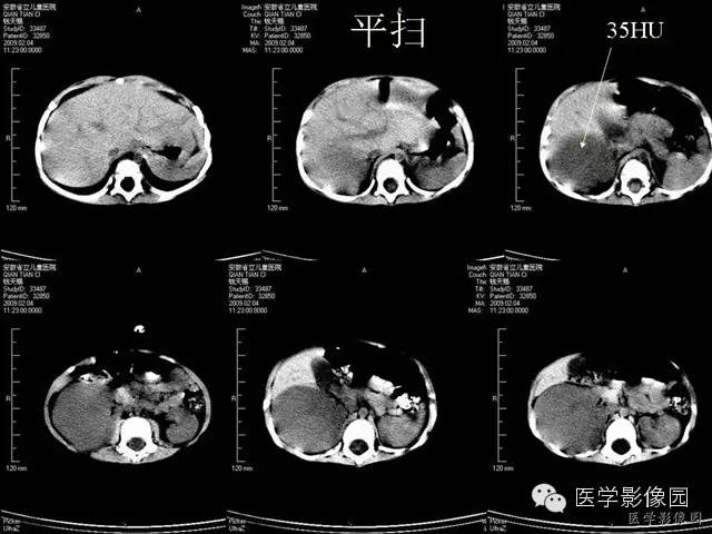 【病例】先天性中胚层肾瘤1例CT影像表现 【病例】先天性中胚层肾瘤1例CT影像表现