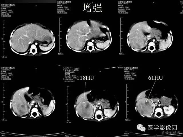 【病例】先天性中胚层肾瘤1例CT影像表现 【病例】先天性中胚层肾瘤1例CT影像表现