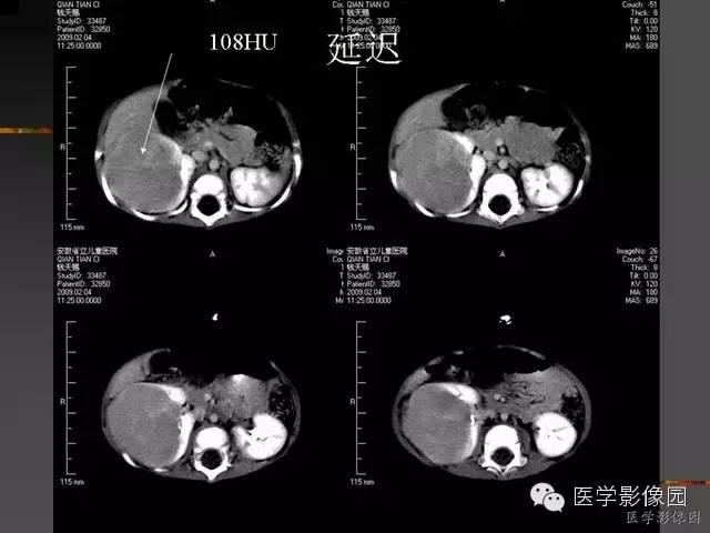 【病例】先天性中胚层肾瘤1例CT影像表现 【病例】先天性中胚层肾瘤1例CT影像表现