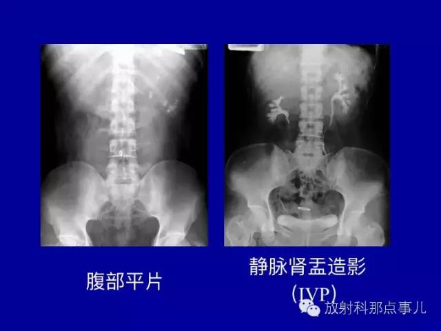 【PPT】泌尿系统常见疾病的影像学诊断