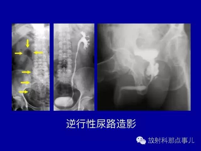 【PPT】泌尿系统常见疾病的影像学诊断