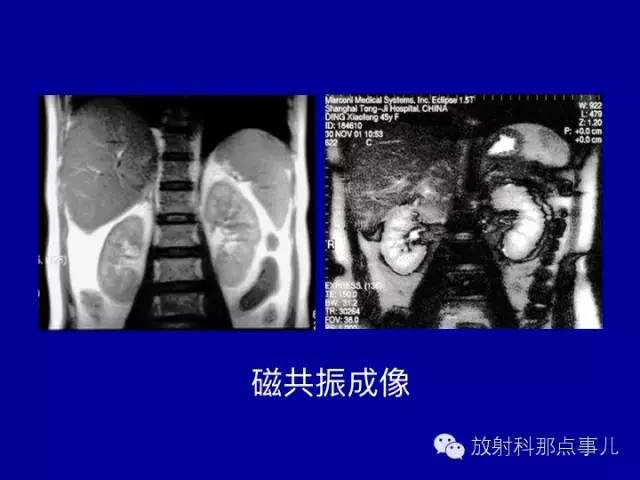 【PPT】泌尿系统常见疾病的影像学诊断