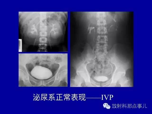 【PPT】泌尿系统常见疾病的影像学诊断