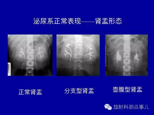 【PPT】泌尿系统常见疾病的影像学诊断