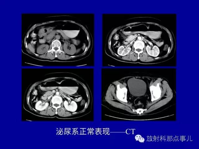 【PPT】泌尿系统常见疾病的影像学诊断