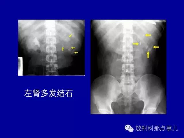 【PPT】泌尿系统常见疾病的影像学诊断