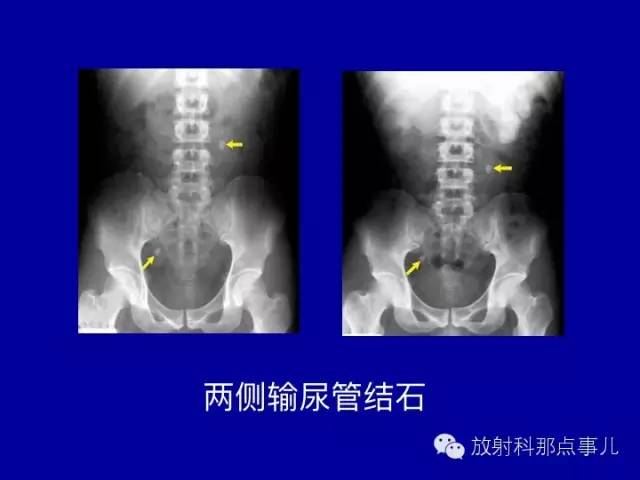【PPT】泌尿系统常见疾病的影像学诊断