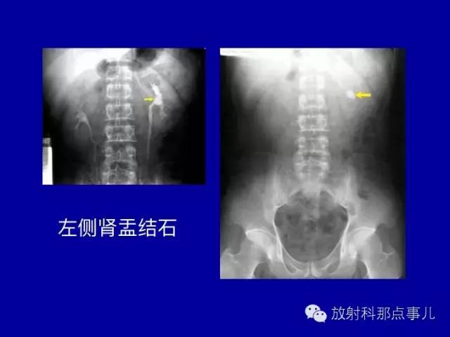 【PPT】泌尿系统常见疾病的影像学诊断