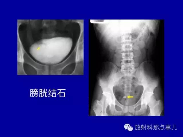 【PPT】泌尿系统常见疾病的影像学诊断