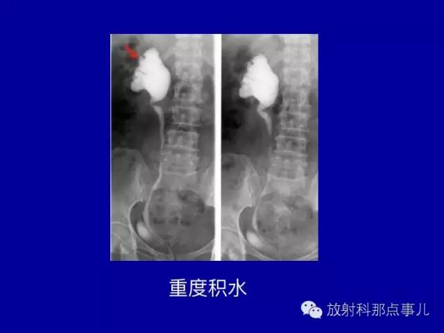 【PPT】泌尿系统常见疾病的影像学诊断