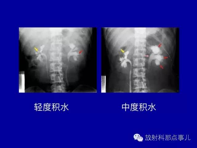 【PPT】泌尿系统常见疾病的影像学诊断