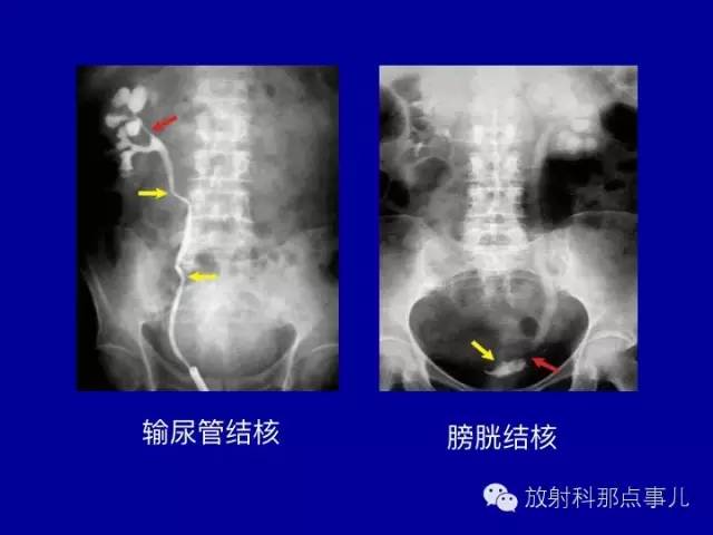 【PPT】泌尿系统常见疾病的影像学诊断
