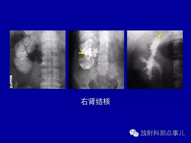【PPT】泌尿系统常见疾病的影像学诊断