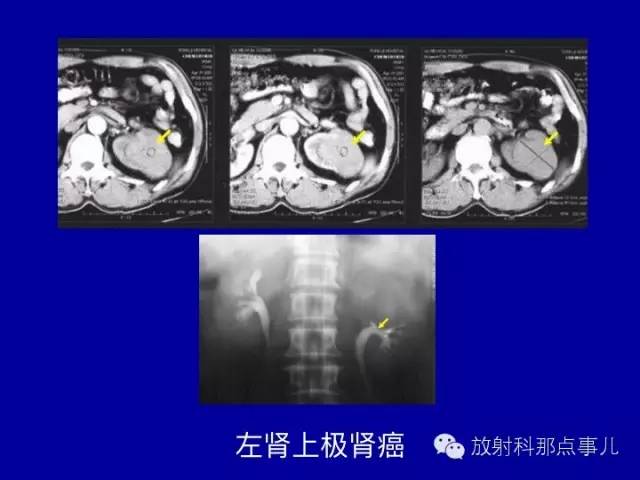 【PPT】泌尿系统常见疾病的影像学诊断