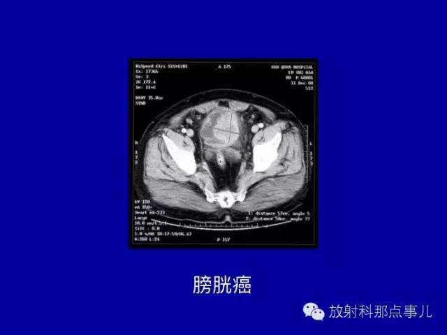 【PPT】泌尿系统常见疾病的影像学诊断