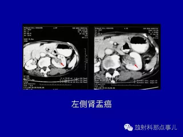 【PPT】泌尿系统常见疾病的影像学诊断