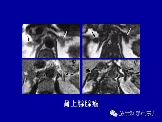 【PPT】泌尿系统常见疾病的影像学诊断