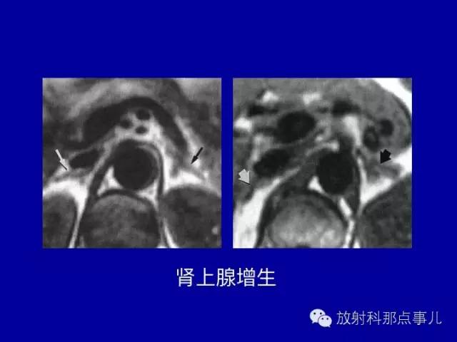 【PPT】泌尿系统常见疾病的影像学诊断