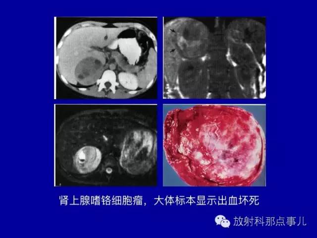 【PPT】泌尿系统常见疾病的影像学诊断