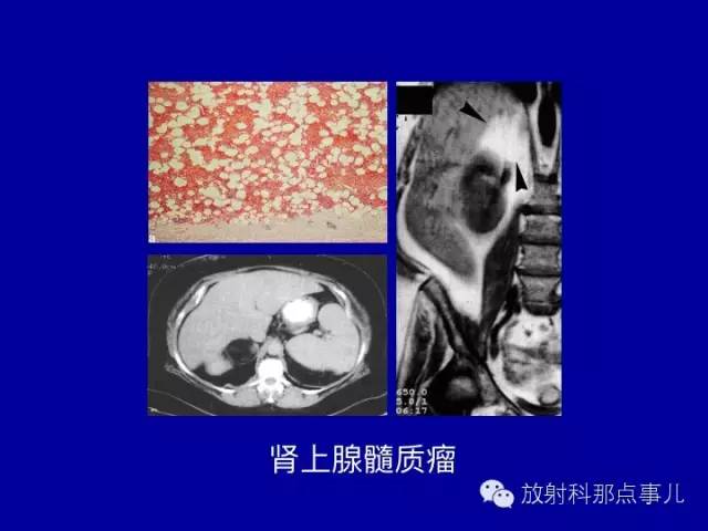 【PPT】泌尿系统常见疾病的影像学诊断