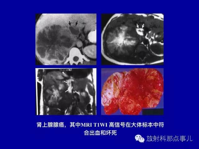 【PPT】泌尿系统常见疾病的影像学诊断