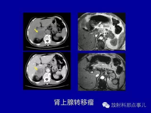 【PPT】泌尿系统常见疾病的影像学诊断