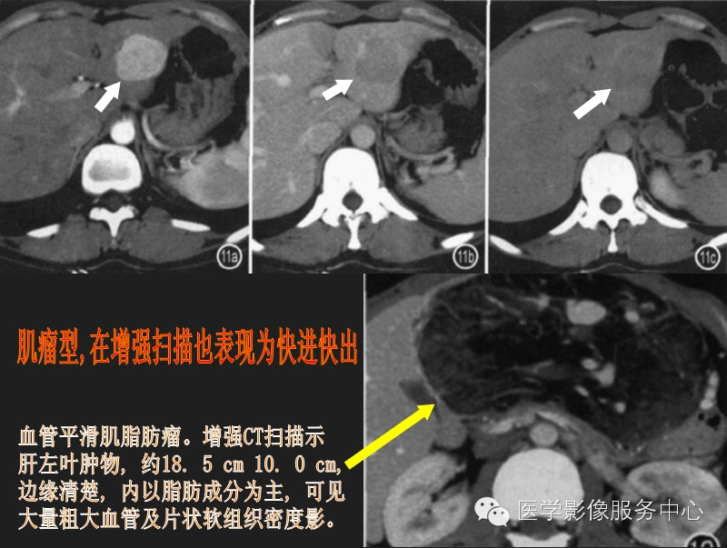 肝脏少见肿瘤及肿瘤样病变的CT诊断 肝脏少见肿瘤及肿瘤样病变的CT诊断