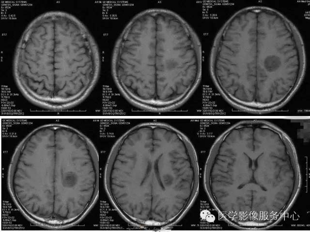 【病例】脱髓鞘假瘤1例MR影像表现
