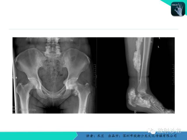 【PPT】蜡泪样骨病
