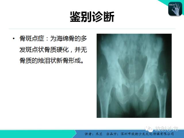 【PPT】蜡泪样骨病