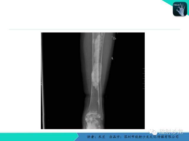 【PPT】蜡泪样骨病