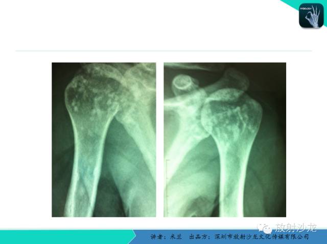 【PPT】蜡泪样骨病