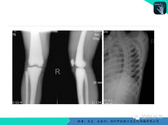 【PPT】蜡泪样骨病