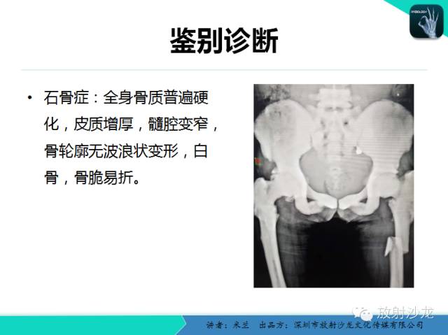 【PPT】蜡泪样骨病