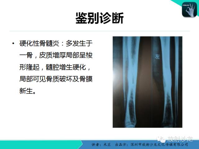 【PPT】蜡泪样骨病