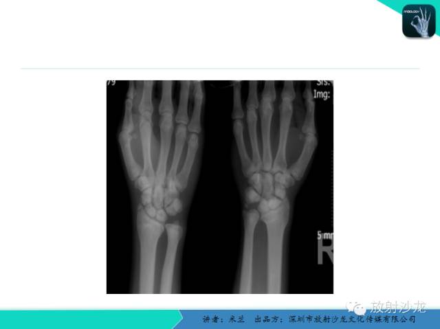 【PPT】蜡泪样骨病