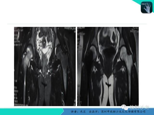 【PPT】蜡泪样骨病