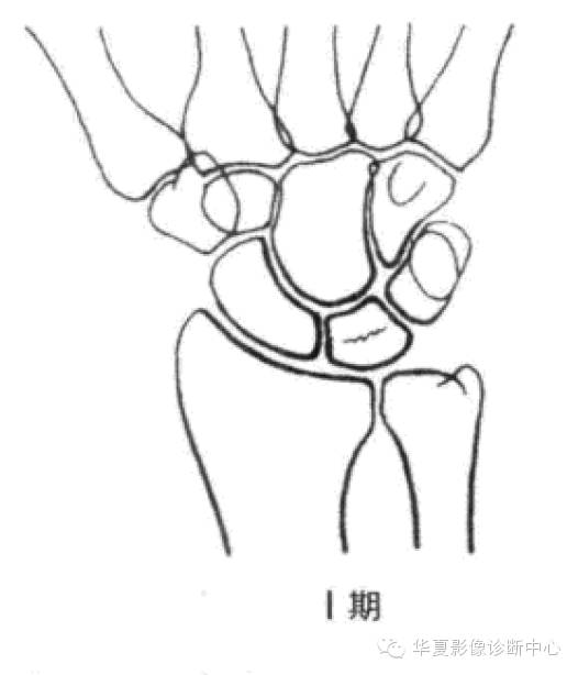 Kienbock病（月骨缺血坏死）Lichtman分期