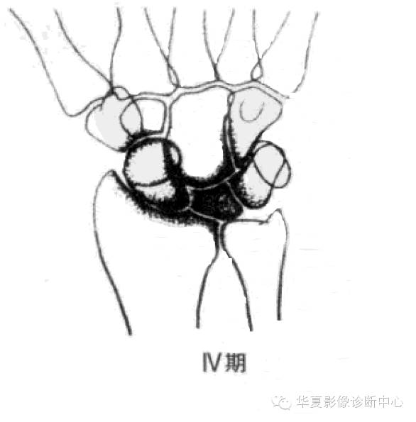 Kienbock病（月骨缺血坏死）Lichtman分期