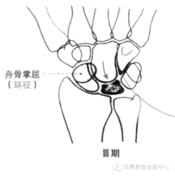 Kienbock病（月骨缺血坏死）Lichtman分期