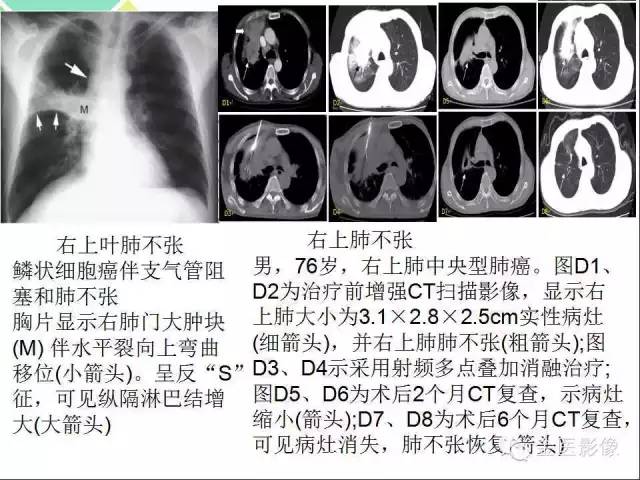 【PPT】肺不张与肺实变的影像学表现