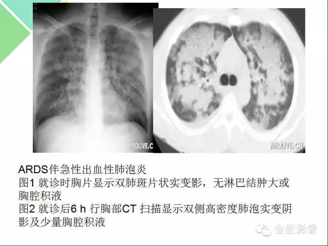 【PPT】肺不张与肺实变的影像学表现