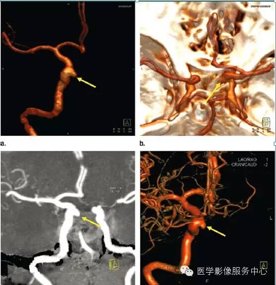 颅内动脉瘤CTA诊断要点汇总(附部分病例解读) 颅内动脉瘤CTA诊断要点汇总(附部分病例解读)