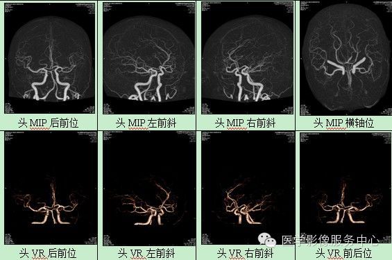 颅内动脉瘤CTA诊断要点汇总(附部分病例解读) 颅内动脉瘤CTA诊断要点汇总(附部分病例解读)