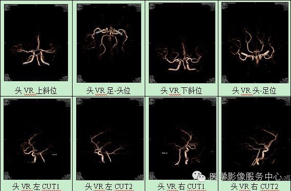 颅内动脉瘤CTA诊断要点汇总(附部分病例解读) 颅内动脉瘤CTA诊断要点汇总(附部分病例解读)