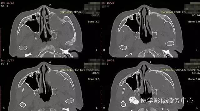 【病例】上颌窦癌1例CT影像表现