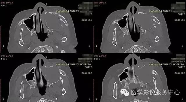【病例】上颌窦癌1例CT影像表现 【病例】上颌窦癌1例CT影像表现